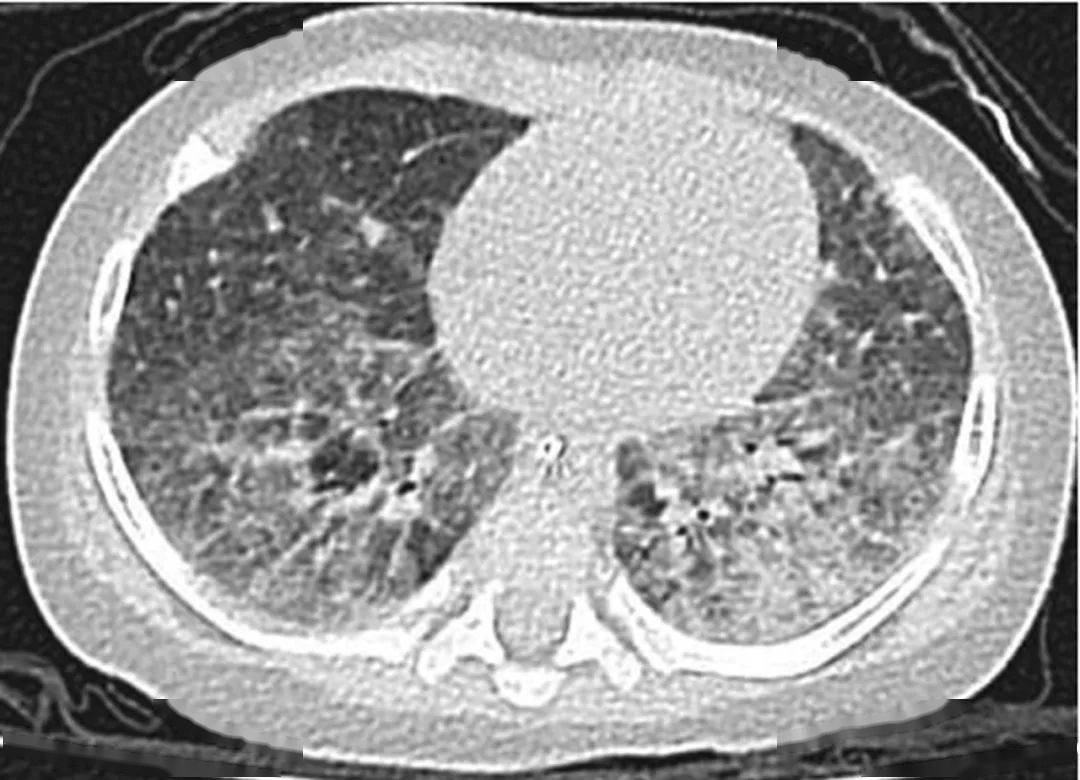 专题笔谈│儿童肺部孢子菌感染的诊治进展_研究_染色_肺泡