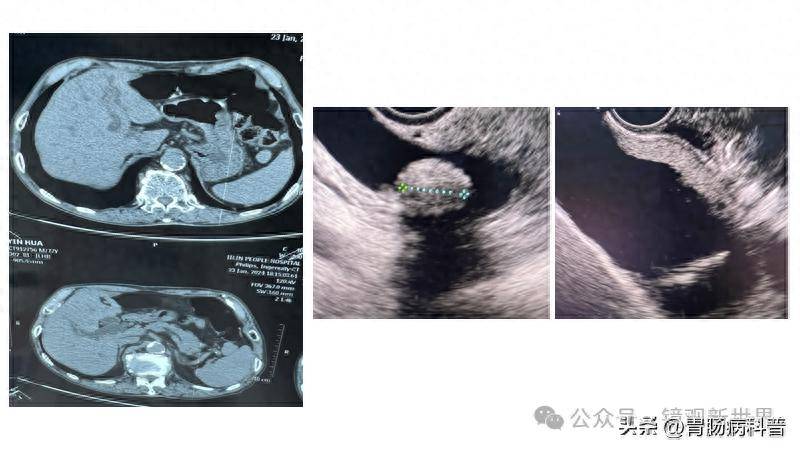 1例胆囊结石的超级微创治疗_患者_病史_腹部