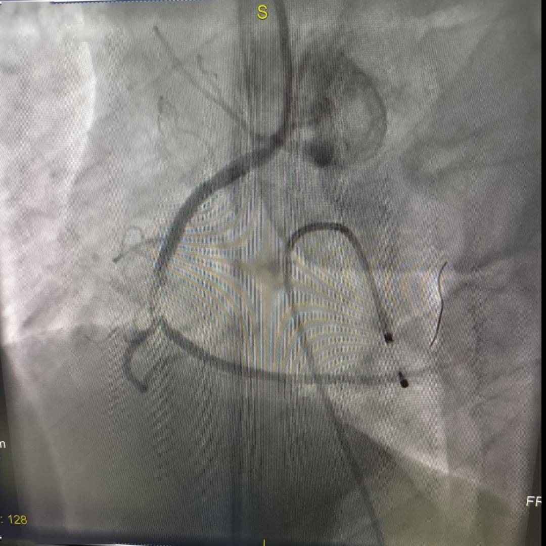 栓塞_支架_冠状动脉