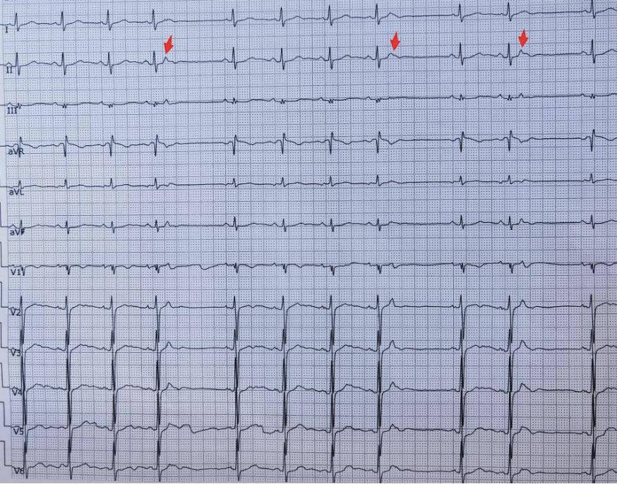 牢记10 个心电图诊断特征,快速鉴别心律失常!_心房_窦性_心室