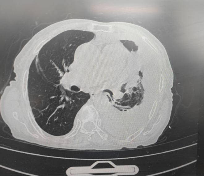 奶奶最近因胸痛,咳嗽,咳痰,气促来医院检查,一做胸部ct发现左侧肺都快