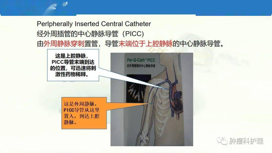 picc导管尖端位置图片