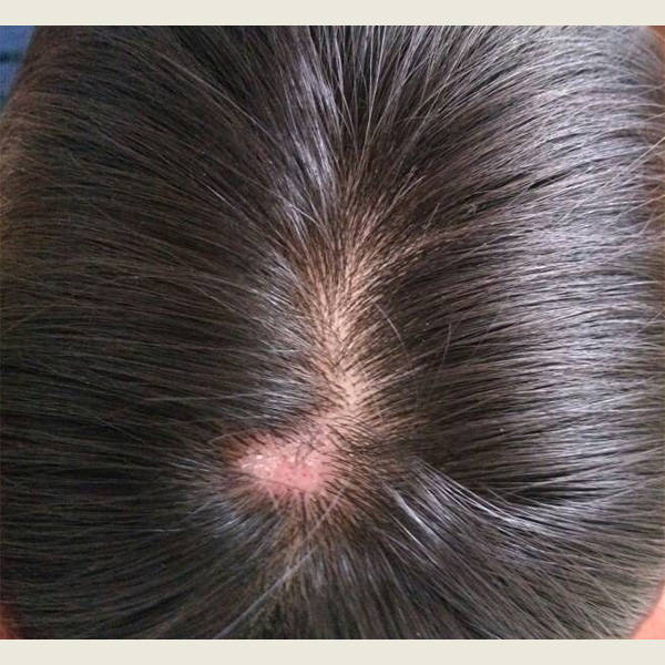 (seborrheic dermatitis):这是一种慢性皮肤炎症,通常由皮脂分泌异常