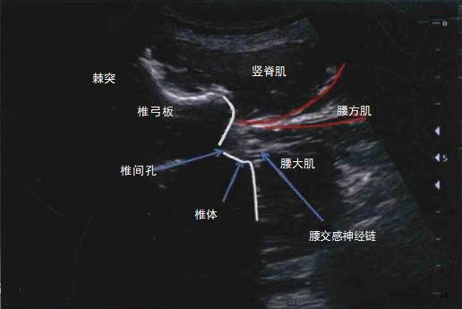 超声股神经阻滞图片