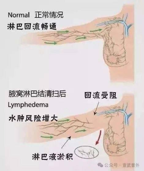 乳腺癌腋窝清扫解剖图图片