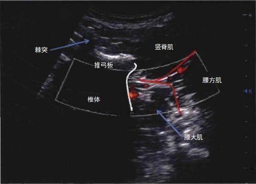 颈椎横突超声图像图片