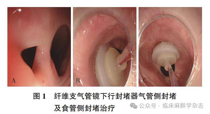 病例报道 |67 气管镜联合胃镜下新型封堵器封堵食管-气管瘘的麻醉
