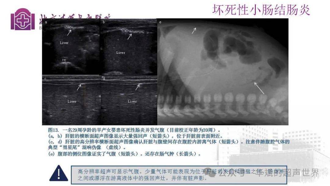 脐瘘超声图片