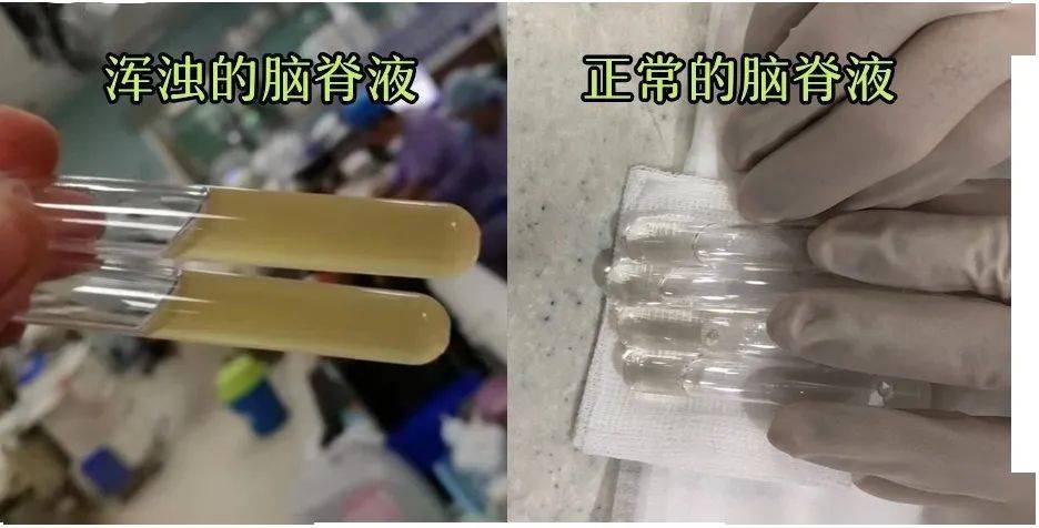 这个杀手你认识它吗?_李斯特_脑室_食物