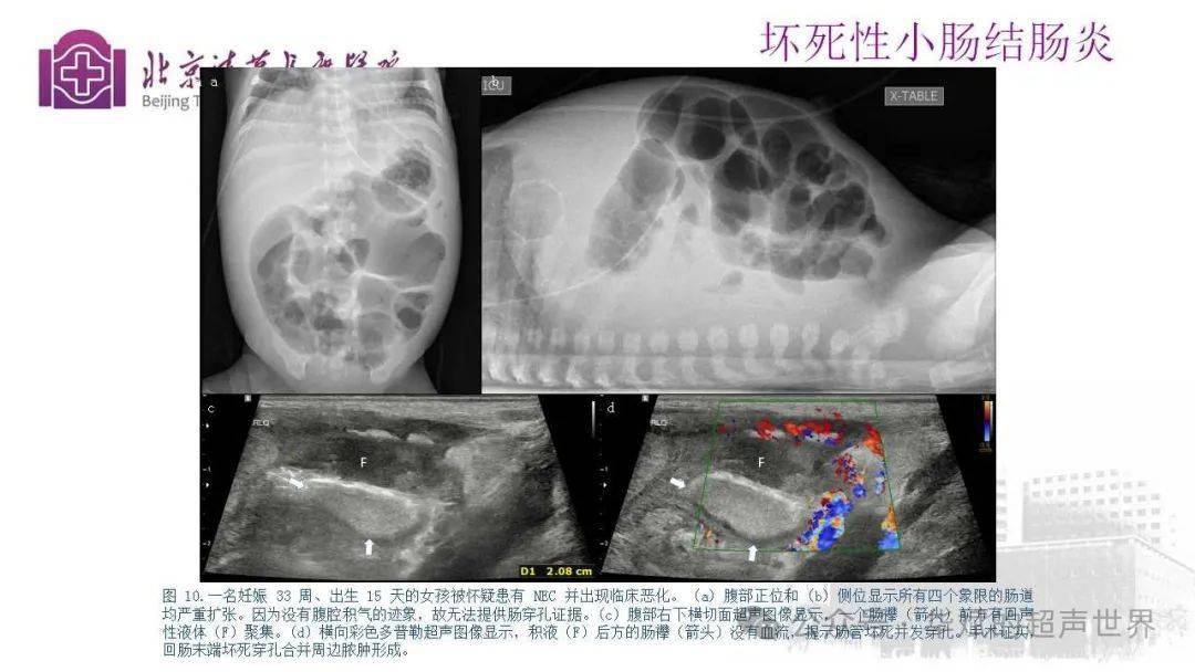 脐瘘超声图片