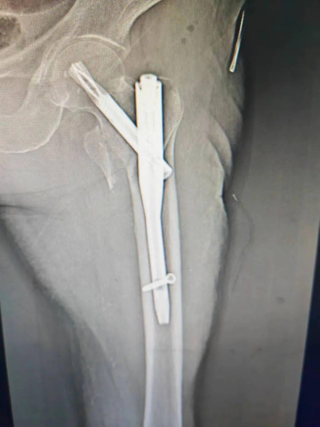 大腿骨折手术全过程图片