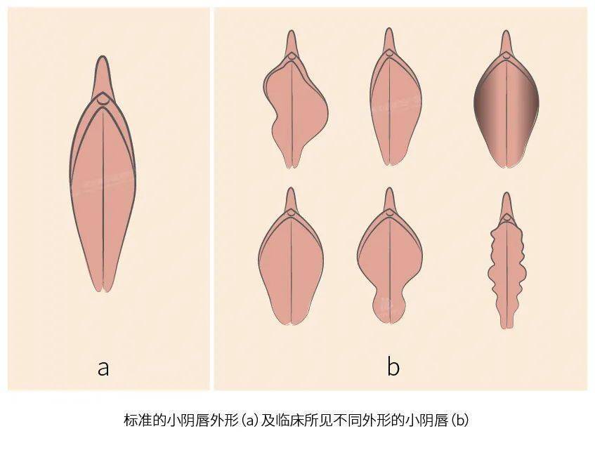 大阴纯粘连图片