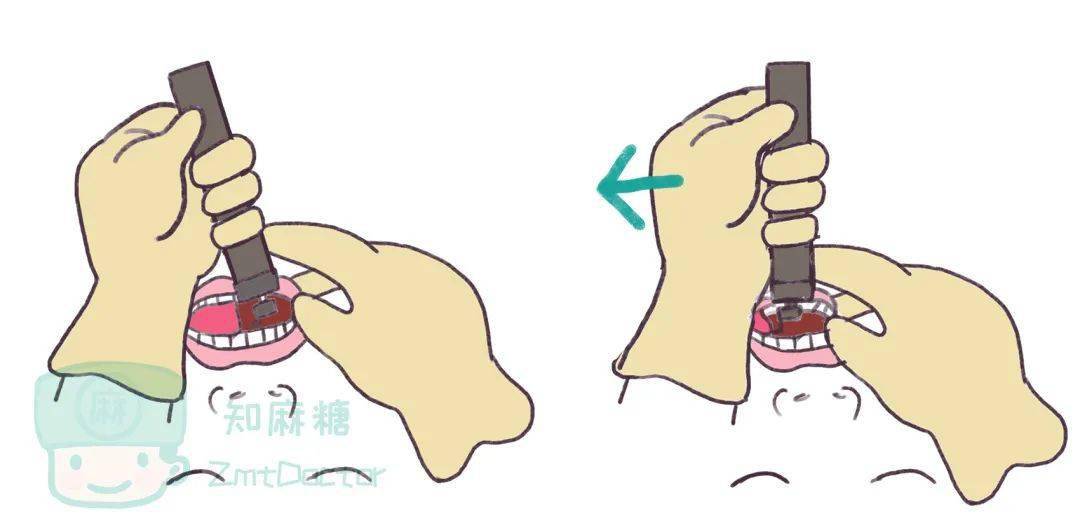 站着气管插管的麻醉科医生