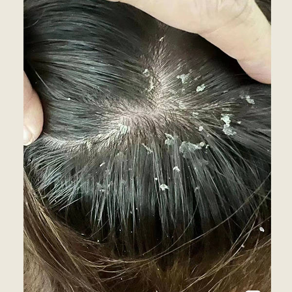 油性头发去头屑用什么洗发水好?_头皮_去屑_成分