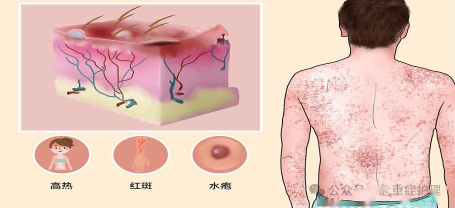 一例中毒性表皮坏死松解症患者护理分享_治疗_药物_皮肤
