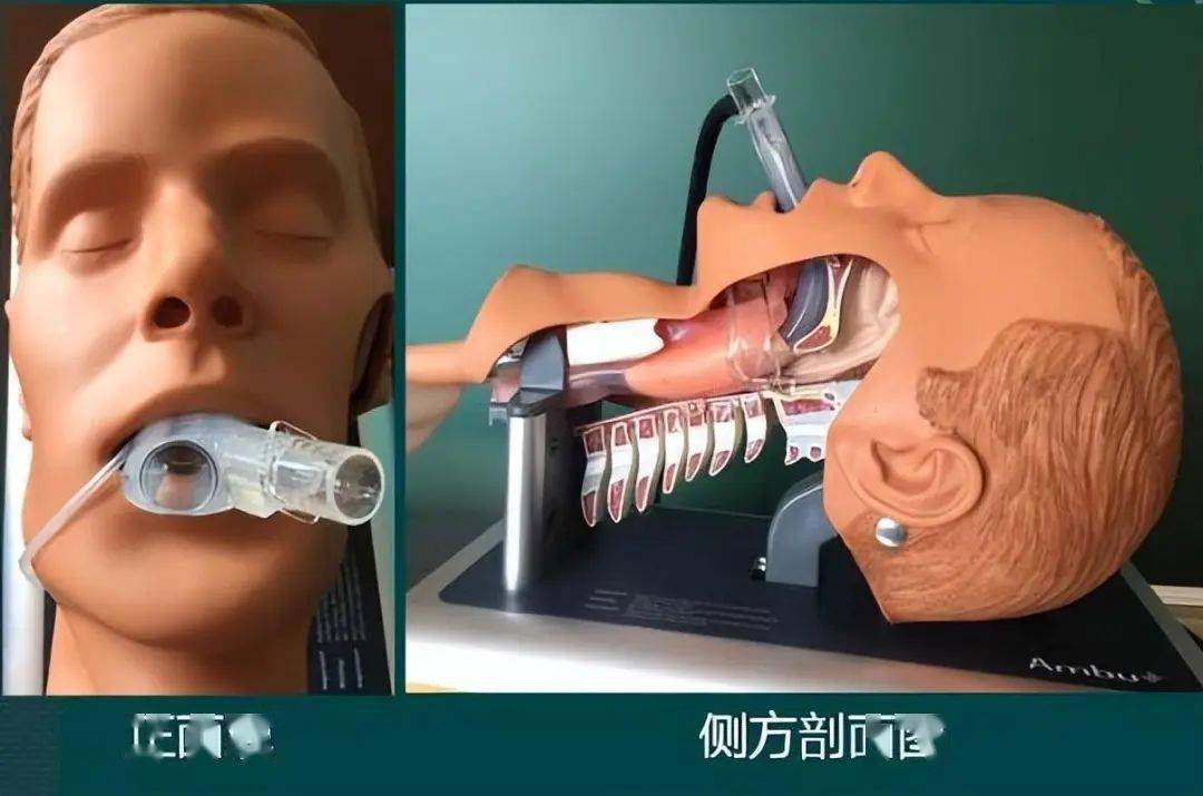 全身麻醉后患者失声的原因与防治_进行_插管_气管