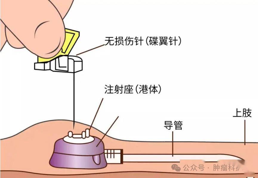 输液港结构图片