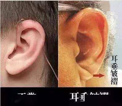 可能存在健康问题_耳垂_皮肤_血管