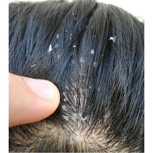 毛囊炎推荐什么洗发水