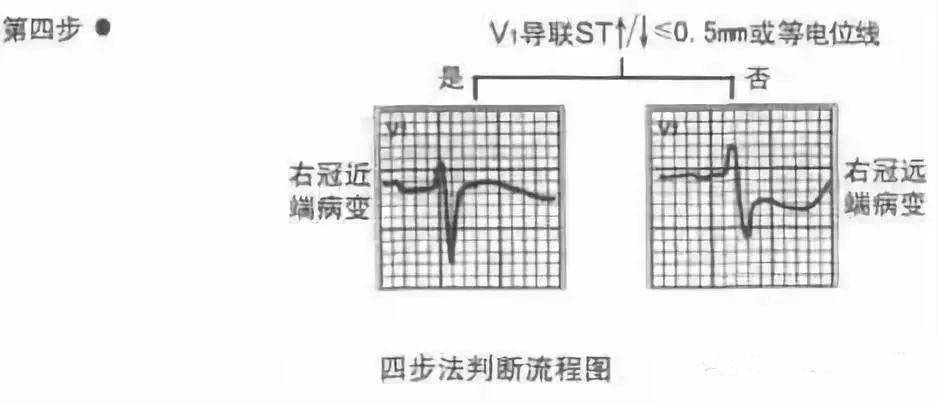 回旋支病变:本壁心电图stii↑>stavf↑>stiii↑;邻壁为高侧壁或前侧壁