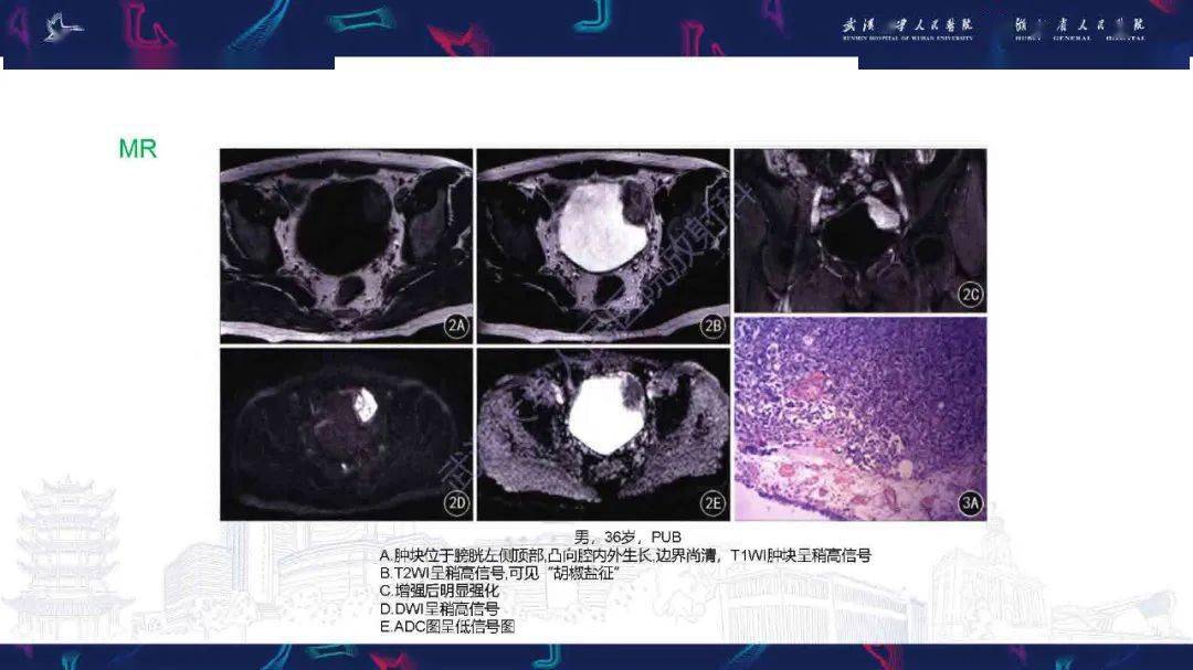 膀胱副神经节瘤影像诊断