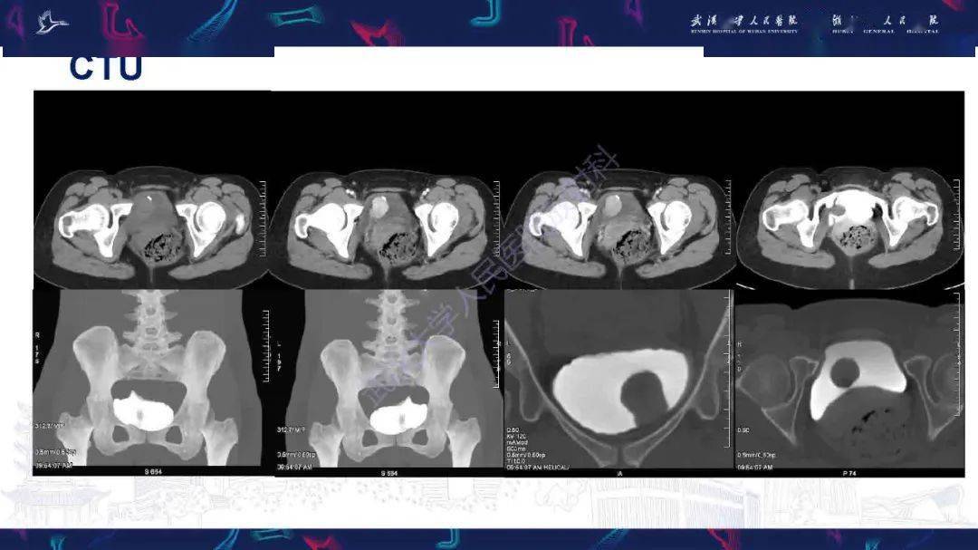 膀胱副神经节瘤影像诊断