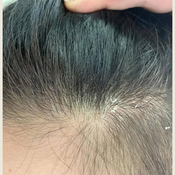 头皮屑多该用什么洗发水