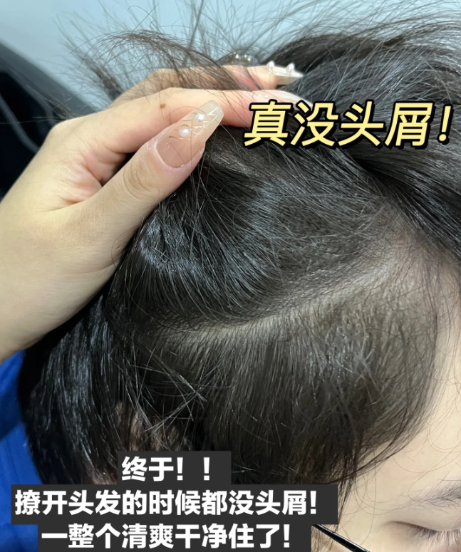 头皮出油有头皮屑用什么洗发水?_头发_问题_去屑