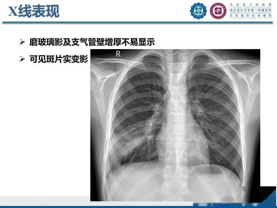 支原体肺炎——支气管内的粘液树