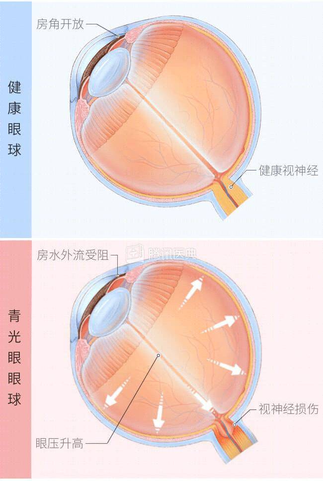 青光眼视野变化图图片