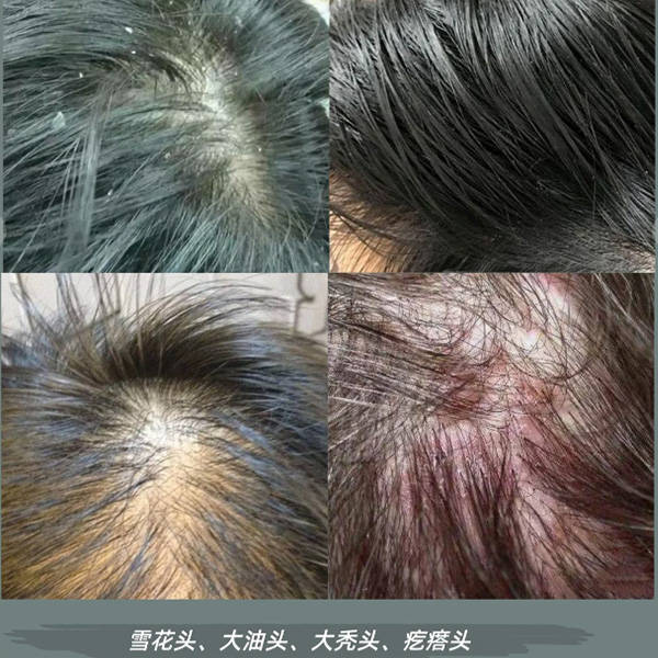 去屑洗发水去屑吗