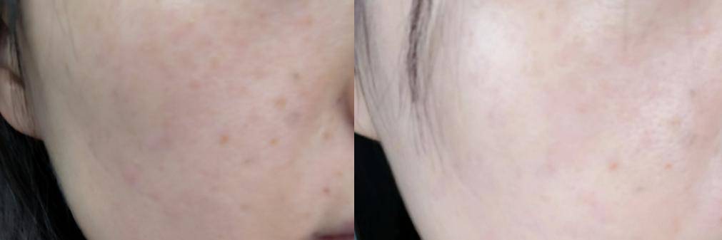 你会发现,脸上开始饱满起来,暗沉的肤色有所改善,小的细纹干纹也慢慢