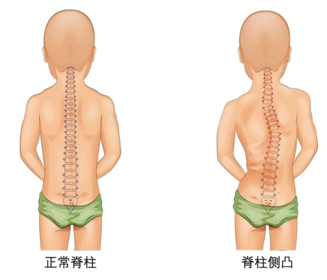 先天性脊椎侧弯图片