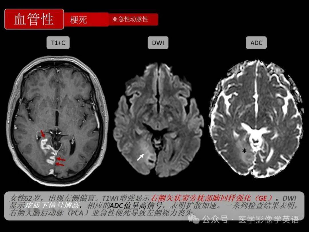 脑回压迹图片