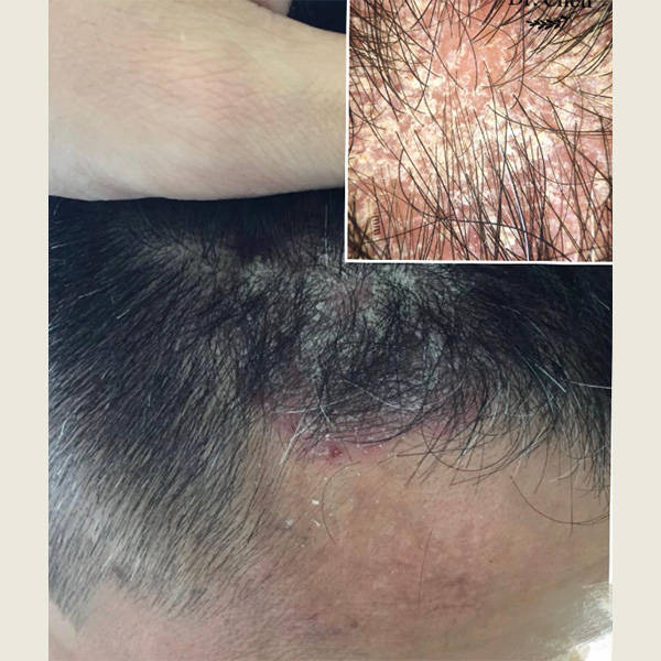 多余的皮脂可滋养酵母生长,引发头皮屑,而皮脂不足可导致干燥和头皮