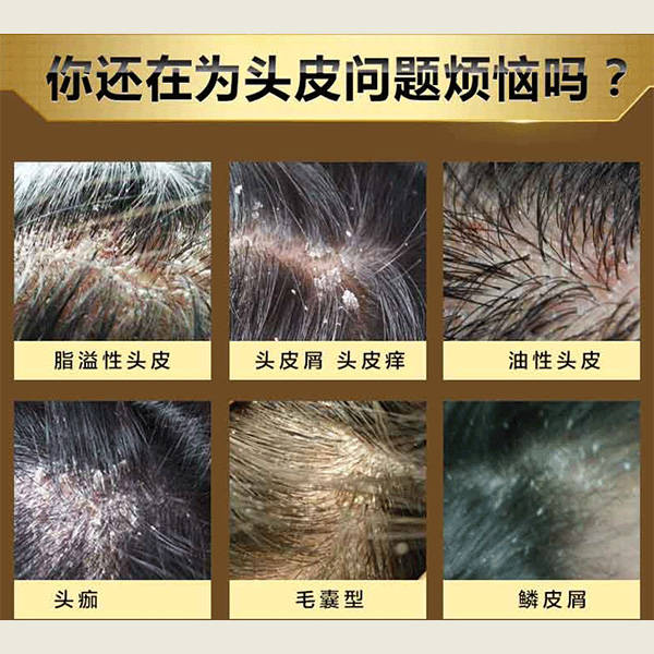 头皮癣头皮屑多用哪个洗发水