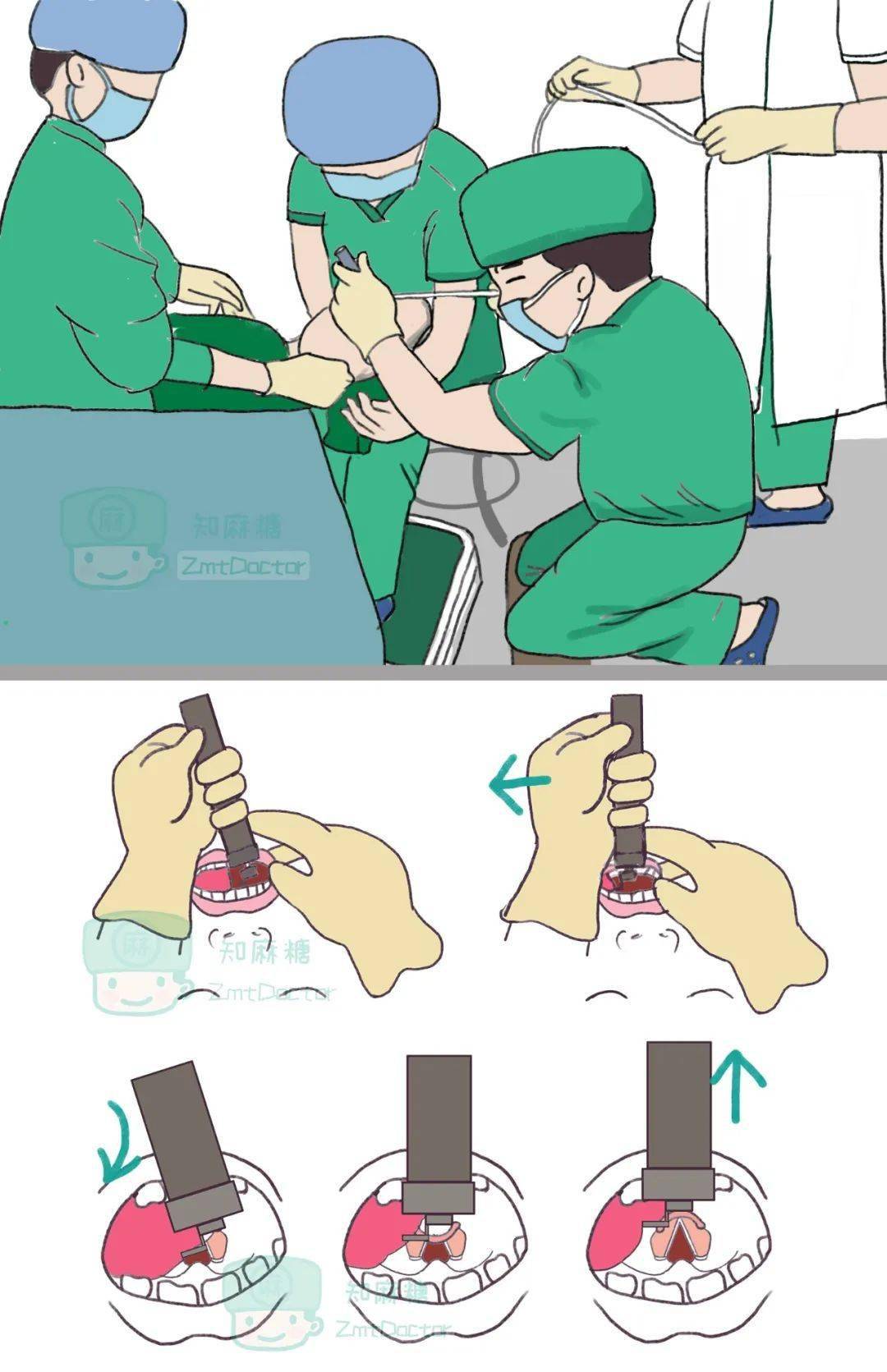 麻醉科医生的手要多练尤其左手