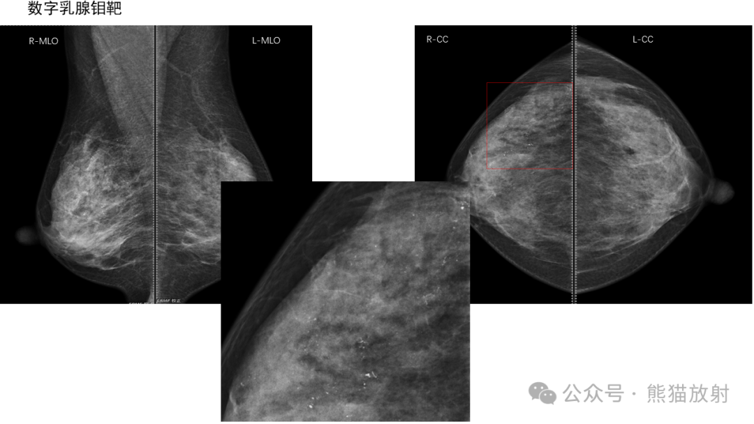 男性乳腺增生b超图片图片