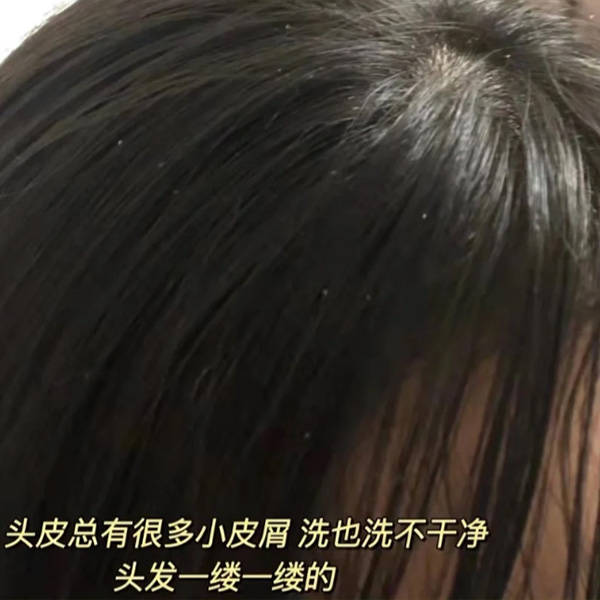 头发_去屑_问题