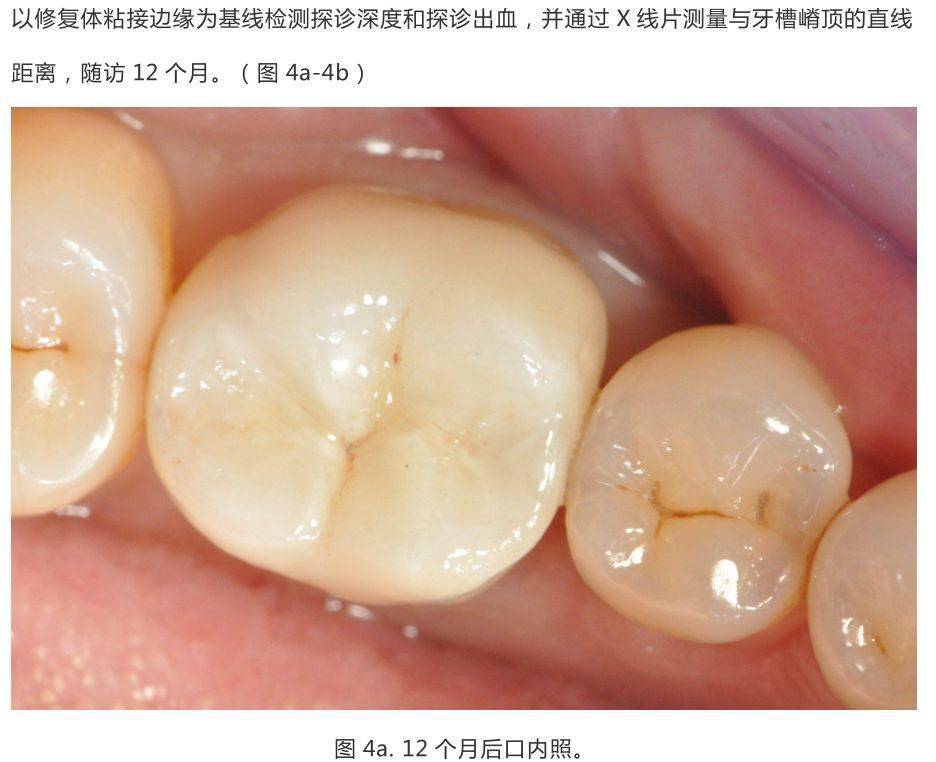 龈壁抬升的研究_边缘_临床_口腔