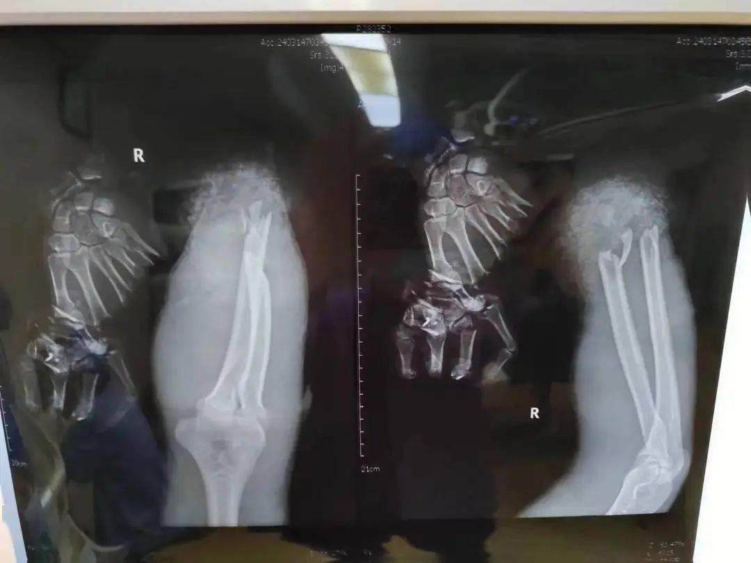 突发苍南一人的手断成4截被送温州