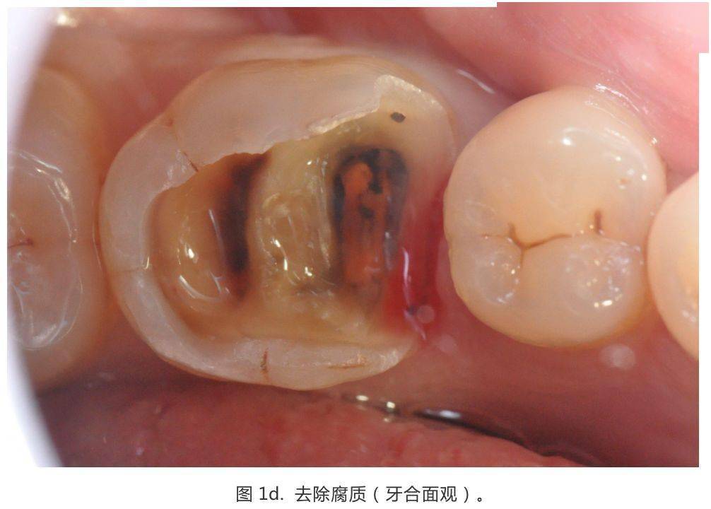 龈壁抬升的研究_边缘_临床_口腔