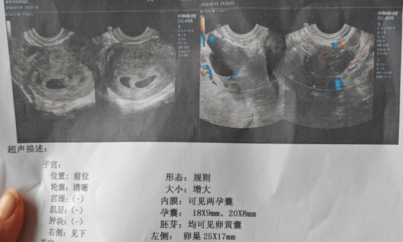 手術很順利,雙側輸卵管正常通暢,自然受孕不再是問題.