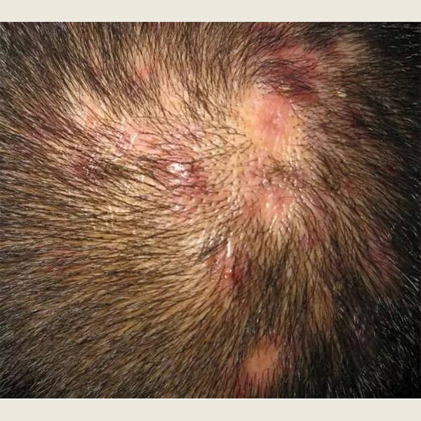 这些症状可能由以下原因引起:皮脂分泌过多:脂溢性皮炎通常由头皮过度