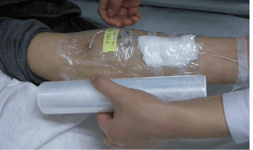 携带picc导管如何做好家庭护理