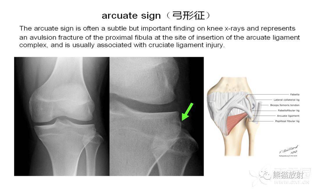 完整汇总18个需要掌握的骨关节外伤特殊征象