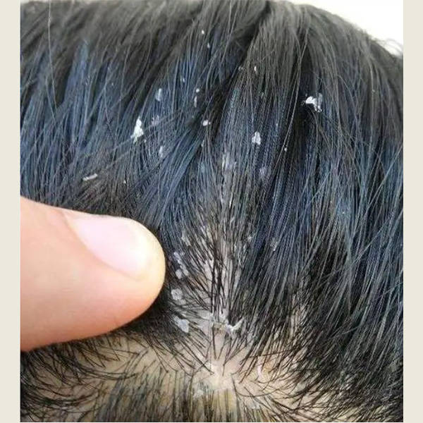 头皮屑通常是脱屑增加的结果,可以由脂溢性皮脂分泌过多,真菌感染(如