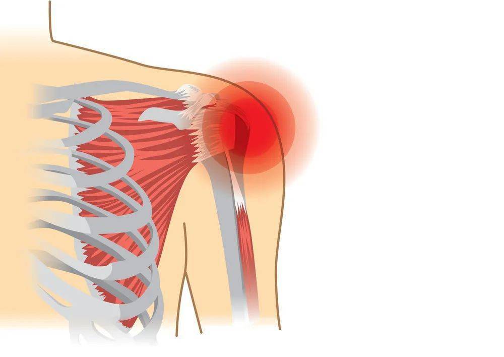 肩袖炎疼痛位置的图片图片