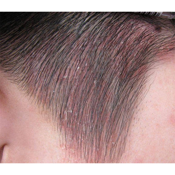 什么样洗发水去屑止痒好用的去屑洗发水介绍