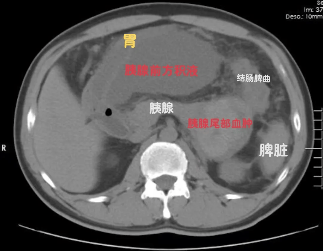 胰周积液不开刀 超声介入来引导